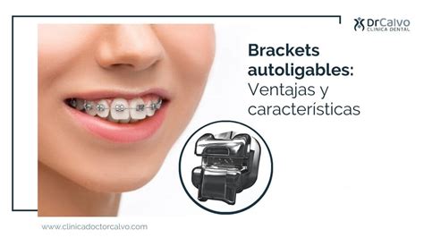 tipos de brackets metalicos autoligables|brackets autoligables beneficios.